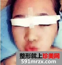 宁波,美莱,双眼皮,45天了,有图有真相哦