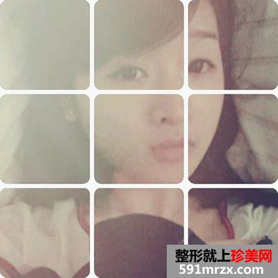 韩式埋线双眼皮手术真实案例分享和前后照片对比