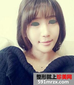 下颌角整形术全过程 花的上万值吗