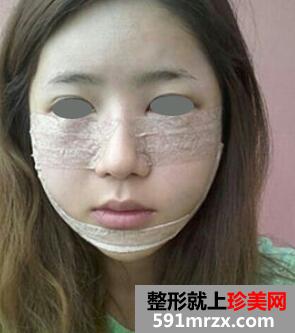 下颌角整形术全过程 花的上万值吗