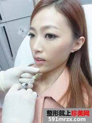 玻尿酸注射丰唇前后效果对比图和恢复过程