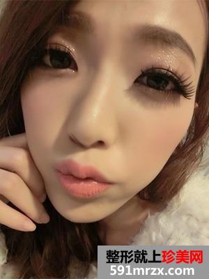 玻尿酸注射丰唇前后效果对比图和恢复过程