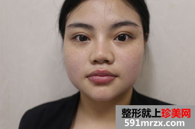 玻尿酸注射丰唇珠前后对比效果图片和恢复过程