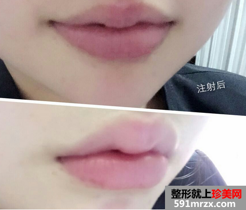 玻尿酸注射丰唇珠前后对比效果图片和恢复过程