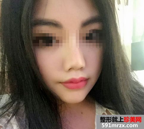 玻尿酸注射丰唇珠前后对比效果图片和恢复过程