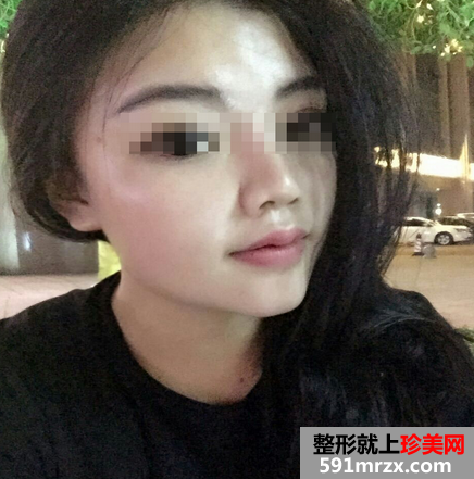 玻尿酸注射丰唇珠前后对比效果图片和恢复过程