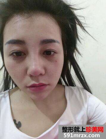 涂抹式超声刀提升前后效果对比图和恢复过程分享