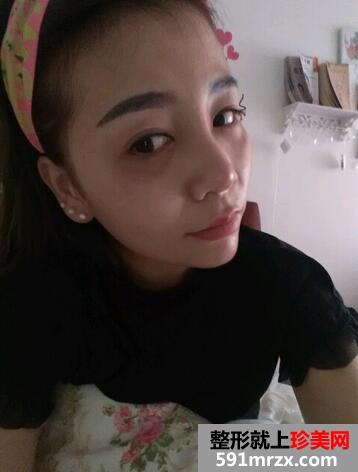 涂抹式超声刀提升前后效果对比图和恢复过程分享