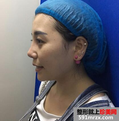 涂抹式超声刀提升前后效果对比图和恢复过程分享