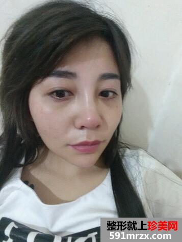 涂抹式超声刀提升前后效果对比图和恢复过程分享