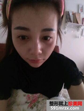 涂抹式超声刀提升前后效果对比图和恢复过程分享