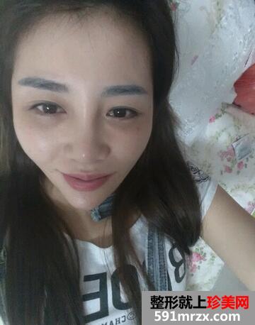 涂抹式超声刀提升前后效果对比图和恢复过程分享