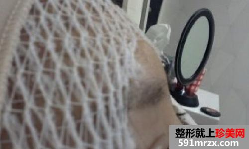 微创颧骨缩小+无下巴整形手术前后效果对比图和恢复过程