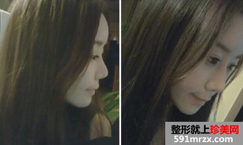 微创颧骨缩小+无下巴整形手术前后效果对比图和恢复过程
