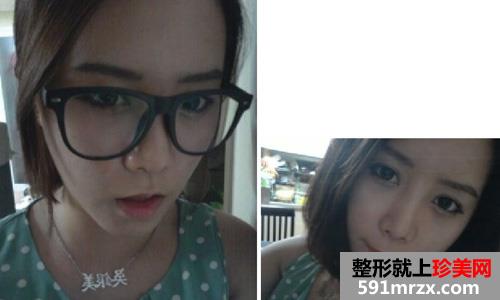 微创颧骨缩小+无下巴整形手术前后效果对比图和恢复过程