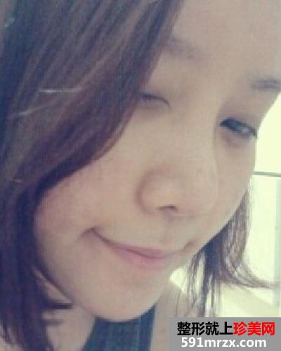 微创颧骨缩小+无下巴整形手术前后效果对比图和恢复过程