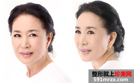 武汉,伊美馨,整形,医院,面部,拉皮,美容,除皱,恢复,过程,效果,对比图