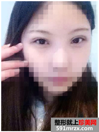 韩式,无痕,开眼角,手术,恢复,过程,前后,效果,对比,照片