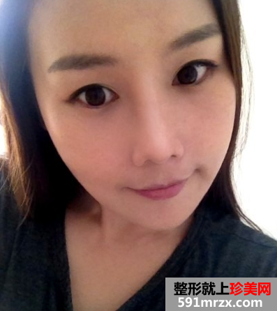 棱角下巴矫正术+硅胶隆鼻整形前后效果对比图和恢复过程