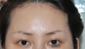 自体毛发无痕植眉前后效果对比图和恢复过程