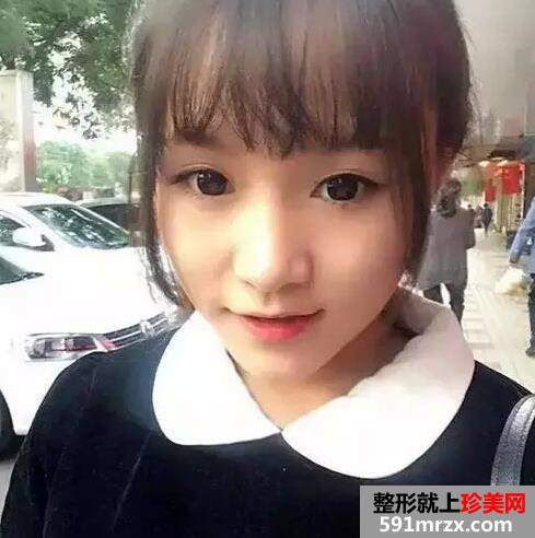 打了botox瘦脸针之后 我也拥有巴掌脸了 打了botox瘦脸针之后 我也拥有巴掌脸了