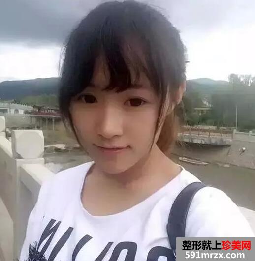打了botox瘦脸针之后 我也拥有巴掌脸了 打了botox瘦脸针之后 我也拥有巴掌脸了