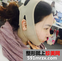 面部吸脂减肥 朋友不再叫我胖子脸