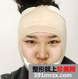 面部吸脂减肥 朋友不再叫我胖子脸