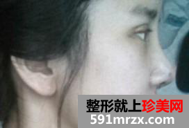 假体隆鼻恢复三十天日记