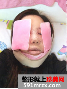 下颌角整形恢复经历 心得分享