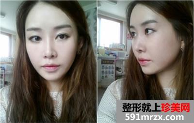 面部轮廓三件套+鼻综合手术真实案例分享和前后对比照