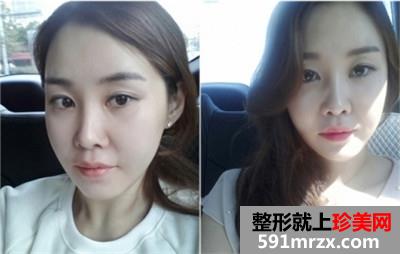 面部轮廓三件套+鼻综合手术真实案例分享和前后对比照