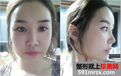 面部轮廓三件套+鼻综合手术真实案例分享和前后对比照