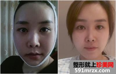 面部轮廓三件套+鼻综合手术真实案例分享和前后对比照