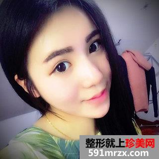取颊脂垫+进口膨体鼻综合整形手术案例分享和前后照片对比
