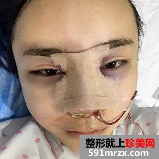 取颊脂垫+进口膨体鼻综合整形手术案例分享和前后照片对比