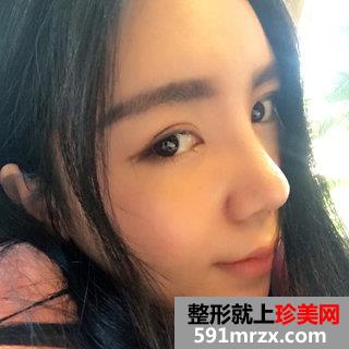 取颊脂垫+进口膨体鼻综合整形手术案例分享和前后照片对比