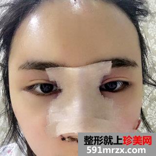 取颊脂垫+进口膨体鼻综合整形手术案例分享和前后照片对比