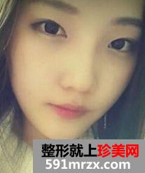 面部轮廓整形+下巴整形带来360度无死角小脸