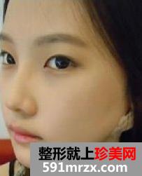 面部轮廓整形+下巴整形带来360度无死角小脸