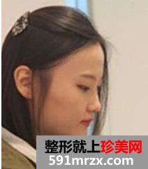 面部轮廓整形+下巴整形带来360度无死角小脸