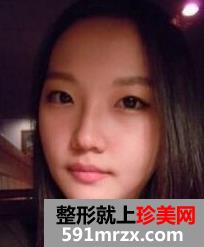 面部轮廓整形+下巴整形带来360度无死角小脸