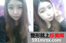 北京新星靓面部整形+隆鼻修复前后对比图