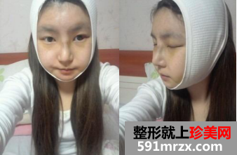 北京新星靓面部整形+隆鼻修复前后对比图