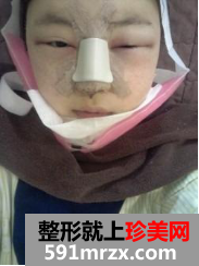 北京新星靓面部整形+隆鼻修复前后对比图
