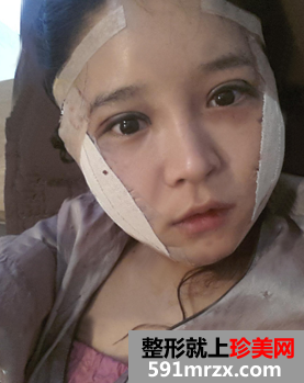 颧骨缩小手术几天恢复 颧骨缩小手术恢复图 颧骨缩小手术几天恢复 颧骨缩小手术恢复图