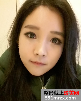 颧骨缩小手术几天恢复 颧骨缩小手术恢复图 颧骨缩小手术几天恢复 颧骨缩小手术恢复图