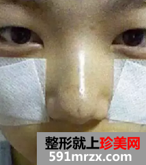 颧骨整形日记 变美需要勇气!