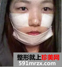 颧骨整形日记 变美需要勇气!