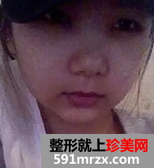 颧骨整形日记 变美需要勇气!